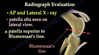 Patellar Tendon Rupture  Everything You Need To Know  Dr Nabil Ebraheim [upl. by Haig]