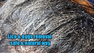 Head lice in children മക്കളുടെ തലയിലെ പേൻ മാറാൻ ചെയ്ത കാര്യങ്ങൾParenting Tips [upl. by Lyrak]