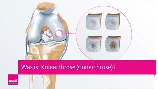 Arthrose im Knie  Was ist Gonarthrose Kniearthrose – Ein Blick ins Innere des Kniegelenks [upl. by Nirraj]