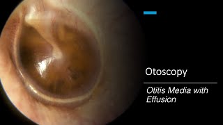 Otitis Media with Effusion Otoscopy [upl. by Waly]