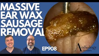 MASSIVE EAR WAX SAUSAGE REMOVED FROM PATIENTS EAR  EP908 [upl. by Akemor]