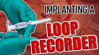 Loop Recorder Implant Procedure [upl. by Hepsiba]