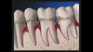 Ultrasonic Scaling for Periodontal Disease Treatment  Lake Merritt Dental Oakland CA [upl. by Yelsek114]