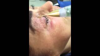 Jett Plasma Lift Medical  Blepharoplasty noninvasive [upl. by Iyre]