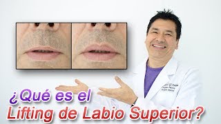 ¿Qué es el Lifting de Labio Superior [upl. by Etterb569]