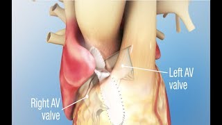 Atrioventricular Blocks AV Blocks  EKG Interpretation  LevelUpRN [upl. by Adnaval]