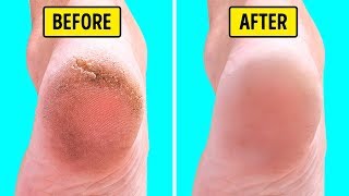 How to Cure Dry Cracked Feet  Cheap Tip 165 [upl. by Ybocaj]