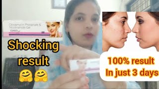 Clinsol gel review in Hindi  Clinsol gel  Pimple free skin naazkhanofficial [upl. by Yelsnya]