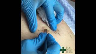 Removal of Seborrheic Keratosis [upl. by Pippa896]