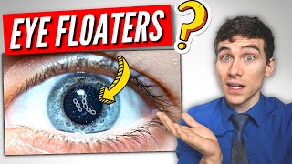 3 Must Know Facts About EYE Floaters [upl. by Rianon944]