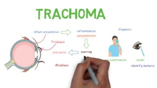 Trachoma  a devastating infectious eye disease [upl. by Ammadas]