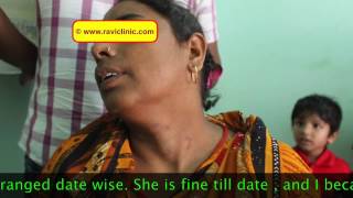 Tinea  Ringworm Homoeopathic cure with real time case studies Dr Ravi Singh [upl. by Treblah535]