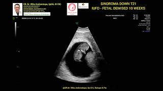 10 weeks sindroma Down T21  IUFD [upl. by Anelec]