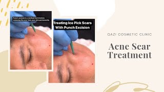 Treating Acne Scars With Punch Excision [upl. by Nosilla375]