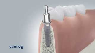 CAMLOG Dental Implant Insertion – 3D Video [upl. by Rayburn]