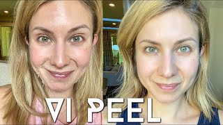 Vi PEEL done at Home  Step by Step Process  Before and Afters [upl. by Arraek]