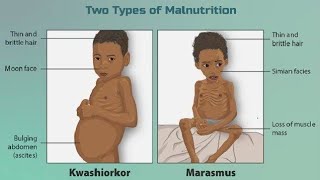 Protein Energy Malnutrition  Kwashiorkor amp Marasmus  Nutritional Disorder  digestion amp absorption [upl. by Mailliw]