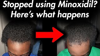 This happens when quitting Minoxidil Experiment [upl. by Vinson]