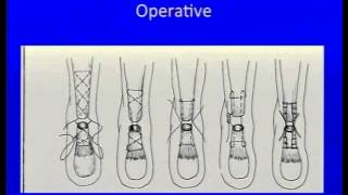 Acute Achilles Tendon Rupture Instructional Lecture and Debates [upl. by Eelsew]