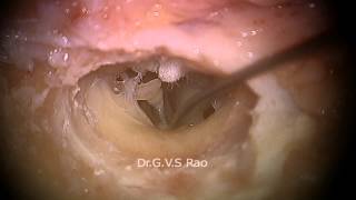 FULL HD  Hands on cadaver Temporal bone dissection Part 1 [upl. by Aihsetal]