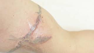 Lynton Lasers Tattoo Removal [upl. by Arac552]