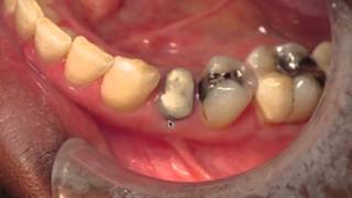 Crown Lengthening and Mandibular Tori [upl. by Fortunna]