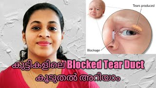 Blocked Tear Duct Or Watery Eyes in Babies  Malayalam [upl. by Ahsiek]