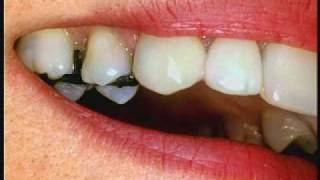 Cosmetic Dentistry Procedures  White Fillings [upl. by Bueschel]