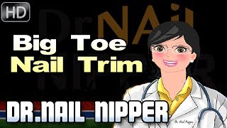 What causes fungus toenail Trimming the Big Thick ToeNail with a Fungal Infection [upl. by Efar524]