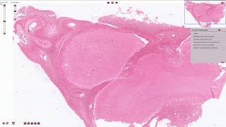 Purulent Meningitis  Histopathology [upl. by Kurr]