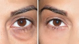 How to Cover Dark Circles  Under Eye Bags [upl. by Ijan]