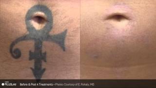 Before amp After Tattoo Removal using PicoSure [upl. by Christean]