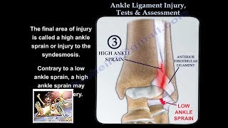 Ankle Ligament Injury evaluation and tests  Everything You Need To Know  Dr Nabil Ebraheim [upl. by Ahsrat664]