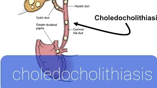 choledocholithiasis [upl. by Valerian]