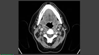 Estudio tomográfico del cuello [upl. by Beatrisa]