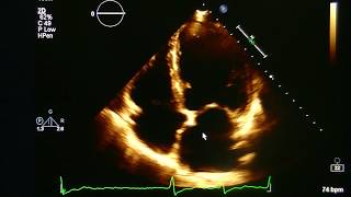 Echocardiogram With Atrial Fibrillation Practice Visual Estimation Ejection Fraction [upl. by Engleman]