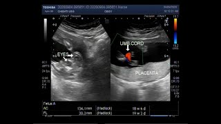 Ultrasound Video showing Anencephaly with a pregnancy of about 19 weeks [upl. by Hcab]