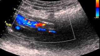 ILIAC ARTERY STENOSIS [upl. by Kenzi]