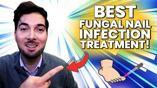 How To Get Rid Of A Fungal Nail Best Treatment [upl. by Nallad]