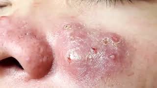 Blackheads amp Milia Big cystic acne blackheads extraction whiteheads Removal Pimple Popping 7 [upl. by Balthasar]