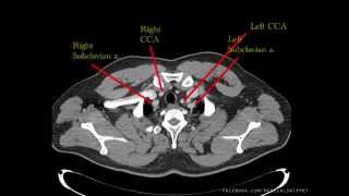 Major Thoracic Vessels  Arteries [upl. by Hildie]