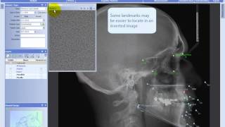 Making analyses in Planmeca Romexis® Cephalometric Analysis module [upl. by Herrle68]