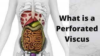 What is a Perforated Viscus [upl. by Auohs988]