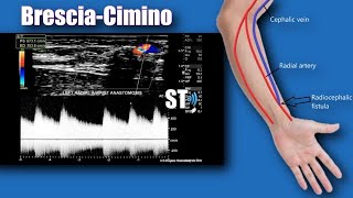 NeonatalInfant Spine Sonography [upl. by Ennylcaj]