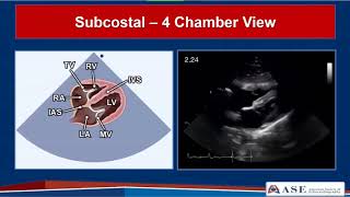 Guidelines for Performing a Comprehensive TTE in Adults Webinar [upl. by Arrait]