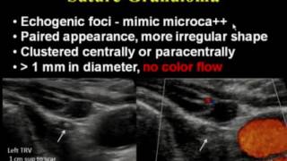 Ultrasound of the Neck Theres More to See Than Thyroid Nodules [upl. by Quinby54]