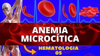 ANEMIAS MICROCÍTICAS  HEMATOLOGIA ESTUDOS DAS ANEMIAS [upl. by Fugazy]