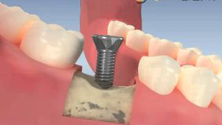 implant boynuna kemik grefti uygulaması [upl. by Erickson]