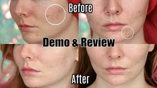 Trophy Skin MicrodermMD REVIEW amp DEMO  Before and After [upl. by Hanid]