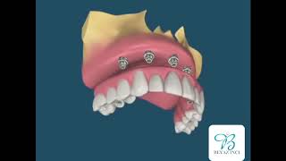 İmplant Üstü Hibrit Protezler [upl. by Omora]
